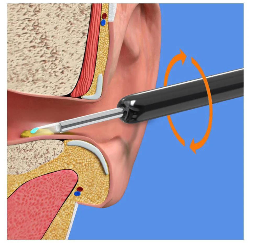 earwax-removal-kit-399-834.jpg