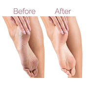 Electric Pedicure Foot File - Callus Remover
