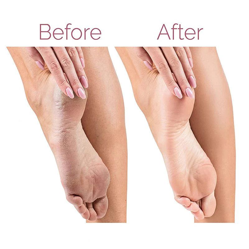 Electric Pedicure Foot File - Callus Remover